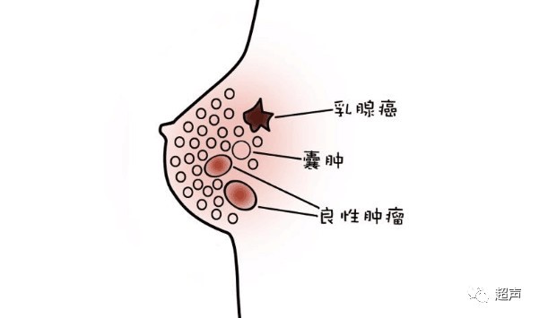 乳腺增生结节严重图片