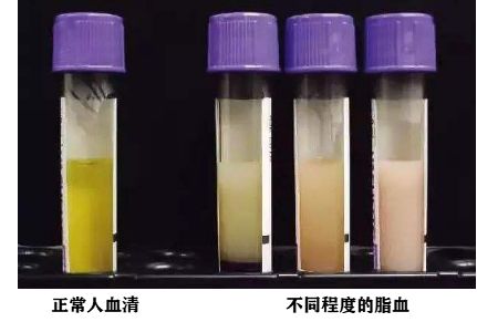 脂血是指血液中血脂浓度的异常增高, 离心后分离出的血清呈乳白色(也