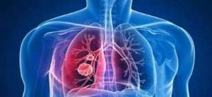 肺癌组