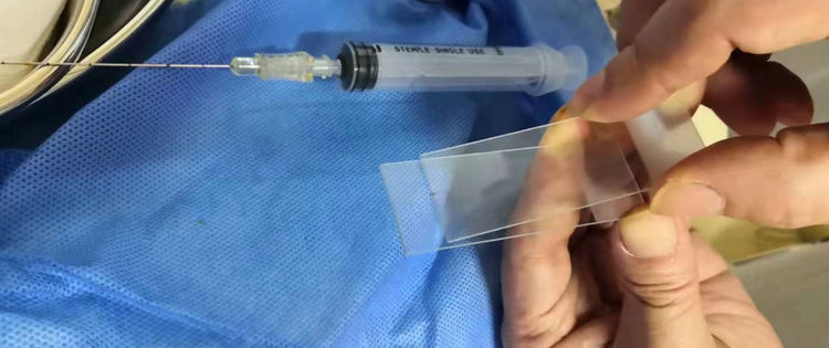 甲状腺结节细针穿刺fna