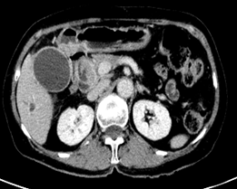 肝外胆管细胞癌